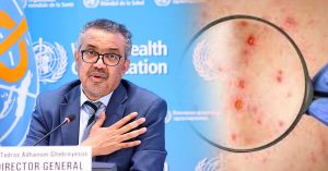 More than 100 monkey pox cases in Europe: World Health Organization convenes emergency meeting