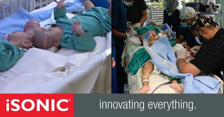 The Siamese twins were successfully separated in Saudi Arabia after a 15-hour operation.