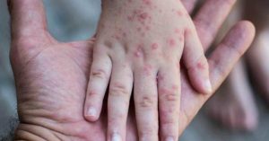 The first monkeypox in the United States-The World Health Organization urges caution