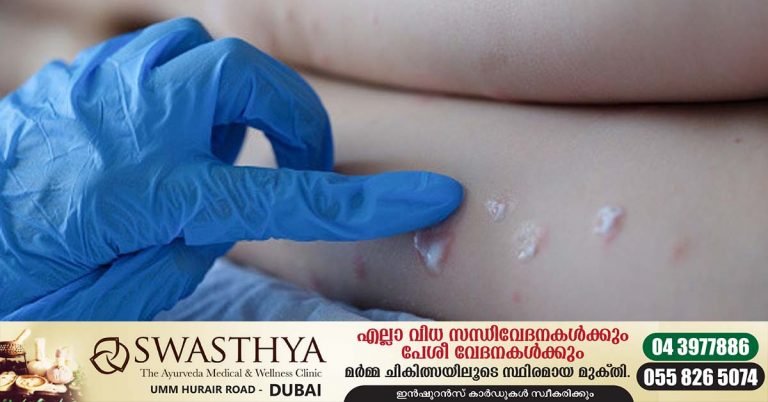Monkeypox already in 13 people in UAE-Dubai Health Authority announces isolation guidelines